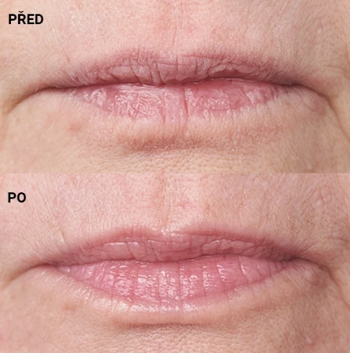 botox rtů_modelace rtů_strivectin_aurio