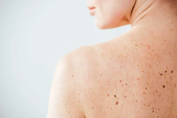 Pigmentové škvrny? Stavte na správne pleťové sérum a ochranu SPF