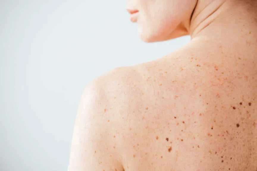 Pigmentové škvrny? Stavte na správne pleťové sérum a ochranu SPF